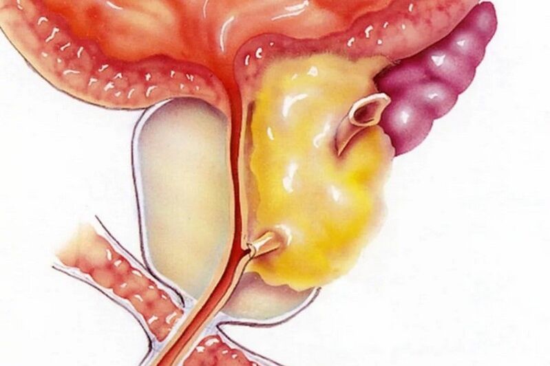 Vnetje prostate
